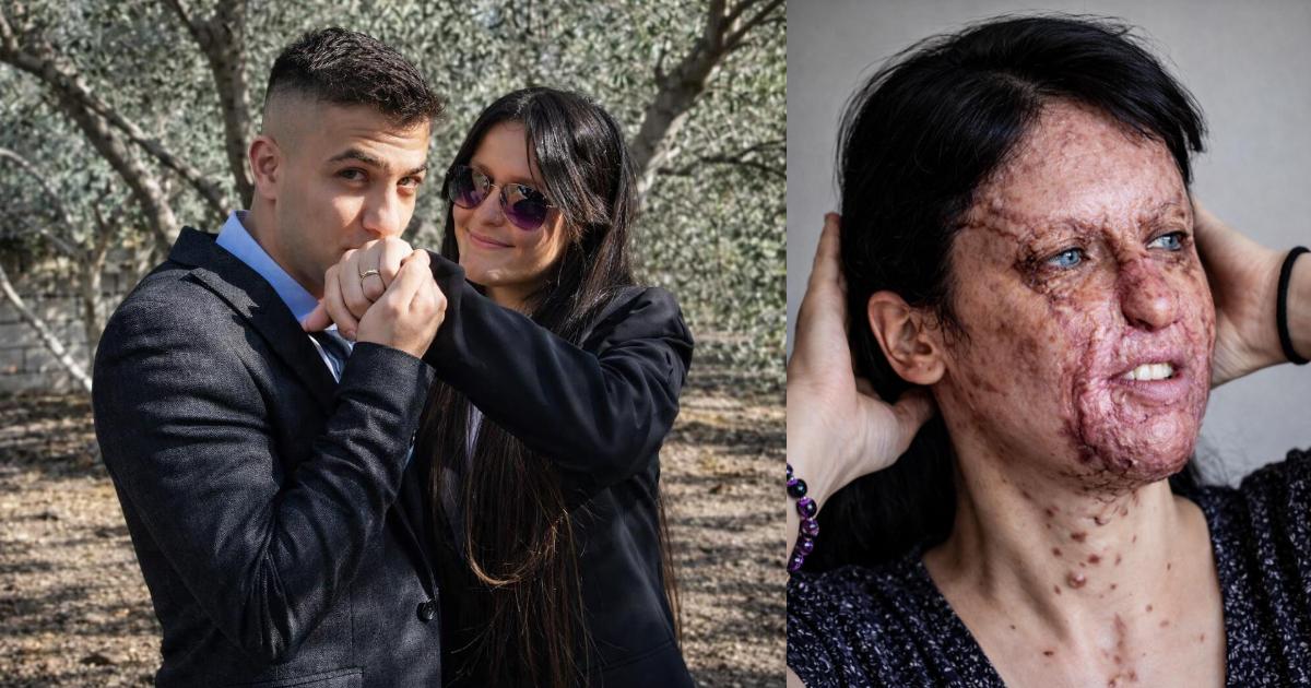 She Survived an Acid Attack. Then She Married Him.
