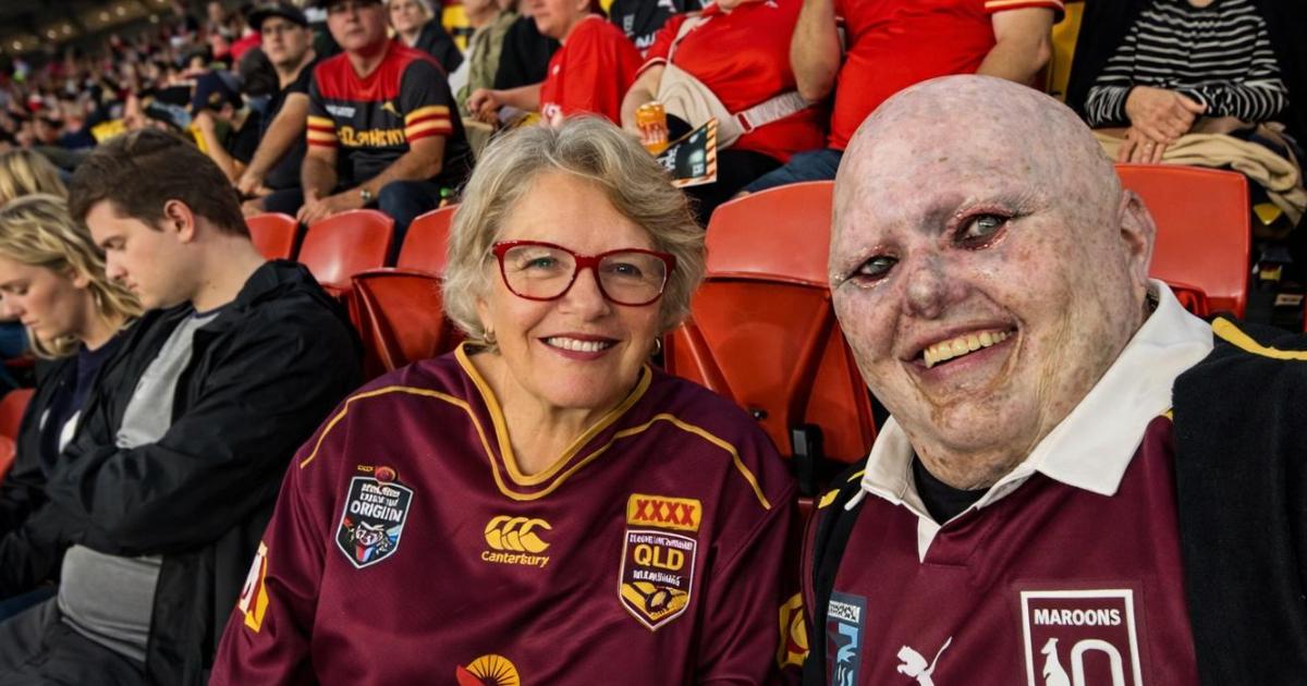 Meta AI Called His Face a Zombie Costume. He Was Born With a Rare Skin Disease.